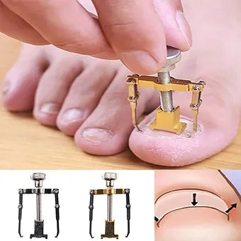 Ingrown Toenail Correction Device