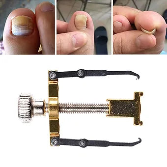 Ingrown Toenail Correction Device