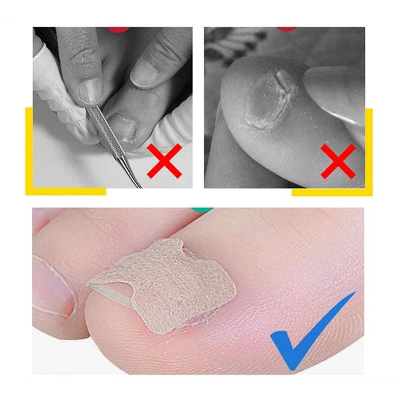 Toenail Correction Stickers