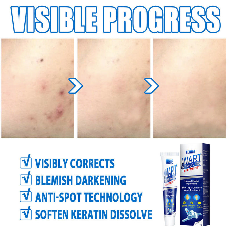 Skin Tag Remover Cream