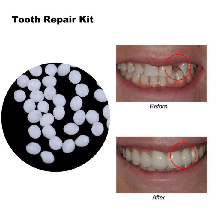 Temporary Tooth Gap Repair Kit