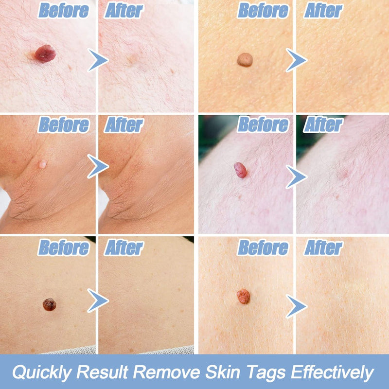 Skin Tag Removal Kit