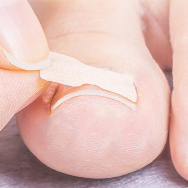 Toenail Correction Stickers