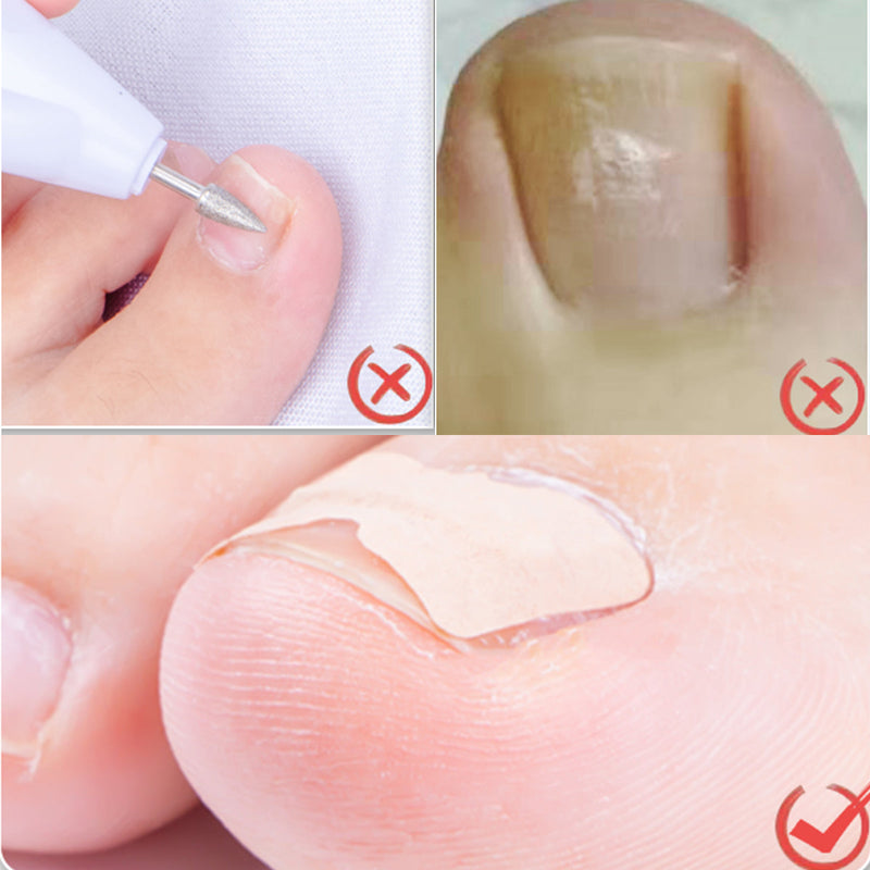 Toenail Correction Stickers