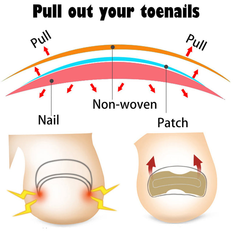 Toenail Correction Stickers