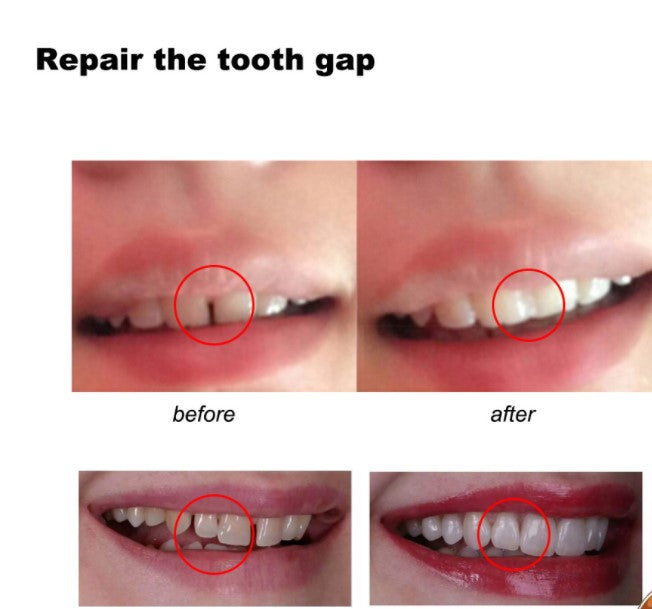 Temporary Tooth Gap Repair Kit